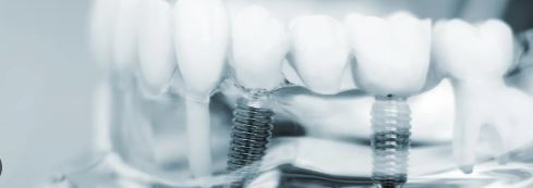 Dental Implants Astoria