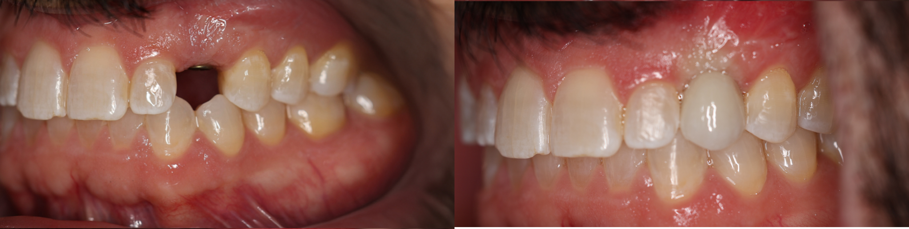 Dental implants NYC
