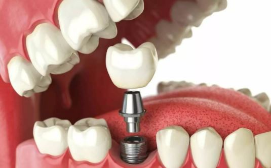 Dental Implants Yonkers